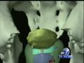 News video: New therapy for prostate cancer